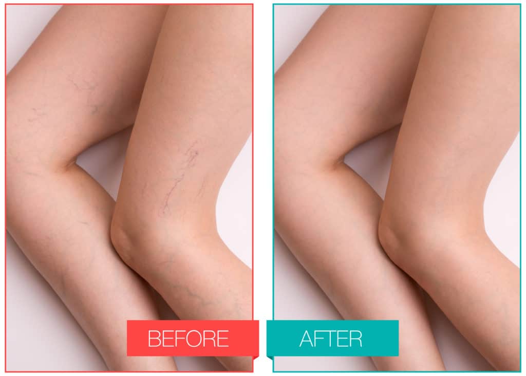 How Laser Technology Lumecca Can Be Used To Treat Spider Veins